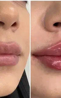 بوتاکس  تخفیفی 945 هزار فیلر لب لاغری prp