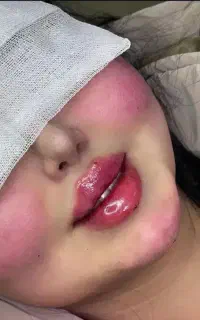 تزریق چربی ، تزریق ژل ، تزریق بوتاکس در مطب