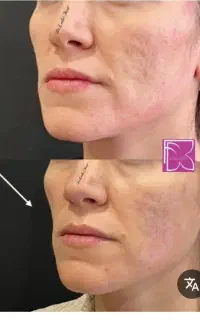 راهنمایی تزریق چربی به صورت