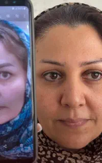 ریمو تتو بدن، ابرو، از بین بردن تیرگی بدن