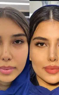 فیلر، مزو، هایفو، فیشیال،