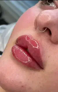 ژل و بوتاکس جهرم