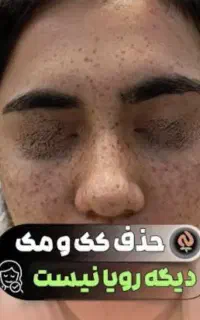 ریموکک ومک فشیال تخصصی صورت