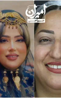 عمل بینی نیمه فانتزی