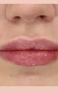 جشنواره تخفیفات بهاری جوانسازی، بوتاکس، مزوتراپی