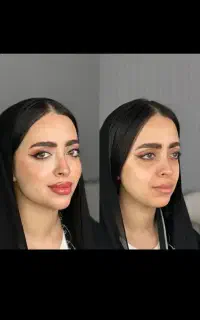 ژل و بوتاکس تضمینی