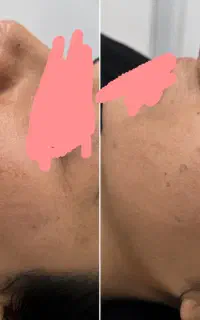 پی ار پی جوانسازی پوست