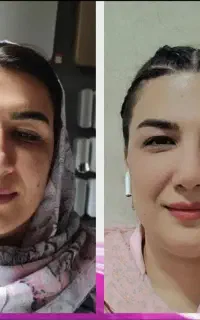 جراحی بینی