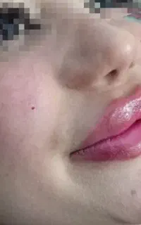 زیبایی تضمینی (ژل و بوتاکس)