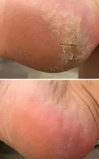 درمان ترک های عمقی پا در یک جلسه پدیکور حرفه ایی