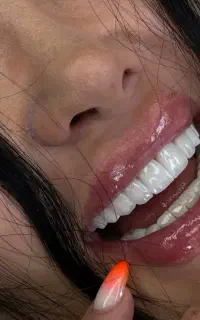 کامپوزیت. شرایط اقساطی .مشاوره رایگان .ایمپلنت