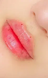 مدل تزریق ژل/فیلر با متدجدید جهت عکسبرداری