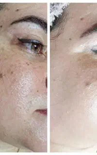 فشیال حرفه ای درمان ۷۰ درصدی در یک جلسه