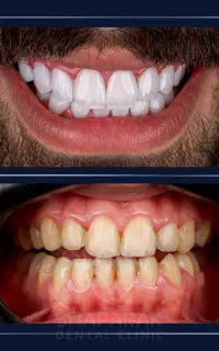 کامپوزیت/لمینت/اقساط12 ماه/دندانپزشکی/ایمپلنت