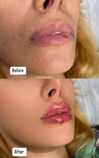 جشنواره اخر فصل تزریق ژل  رئوفیل هر سیسی ۲ ملیون