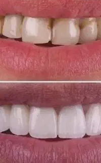 لمینیت دندان واحدی ۶ میلیون تومان