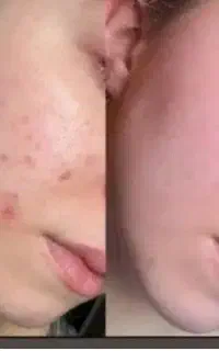 کرم ترمیم کننده رفع جای زخم، و جوش و بخیه