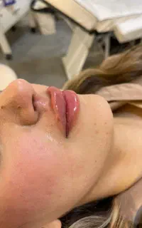 فیلر بوتاکس