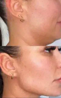 تزریق ژل و بوتاکس.هیپ دیپ