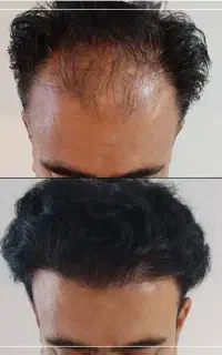کاشت مو / شیراز / تراکم حداکثری