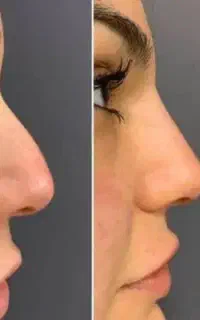 ژل، بوتاکس و فیشیال صورت
