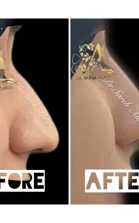 فرم دهی بینی بدون جراحی توسط پزشک