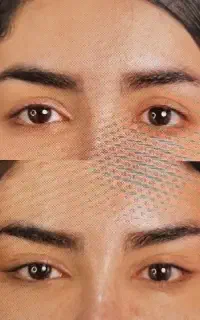 تخفیف تکرار نشدنی لیفت شقیقه و گونه با بخیه لیزری