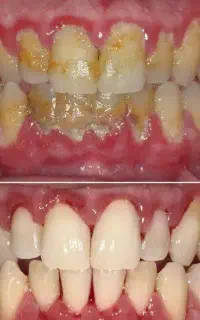 جرمگیری و بروساژ دندان 2.980