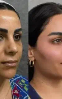 بوتاکس ژل فقط ۱/۱۰۰ فول فیس فقط ۱۱ت