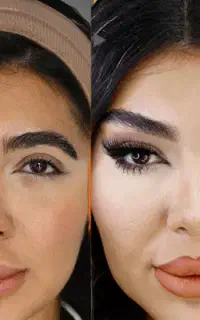لیفت فول فیس صورت و شقیقه بدون عمل جراحی