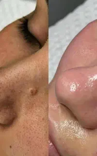 پاکسازی و فیشال پوست