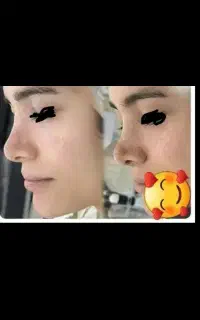 پاکسازی و جوانسازی پوست