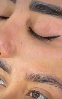 پاک کردن تتوی ابرو و بدن با دستگاه کیوسوئیچ