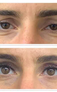 نیاز به مدل جراحی مکس لیفت صورت دایرکت ابرو