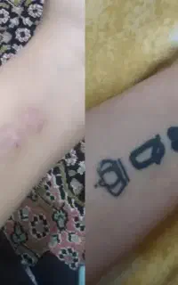 پاک کردن تتو و برداشت خال و زگیل