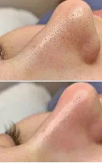فیشال کار/اسکالپ سر/فیبروزکار/پیرسینک کار