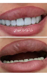 دندانسازی سکندری کرمان دندان ایتالیایی لثه نرم