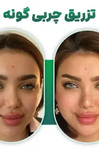 ژل فیلر بوتاکس