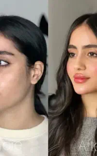 ژل،بوتاکس،چربی،پاک کردن تتو