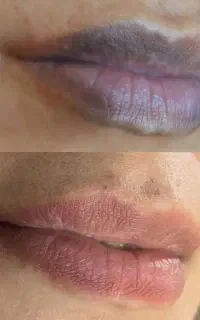 جشنواره تخفیفی شیدینگ لب واصلاح تیرگی و بدرنگی لب