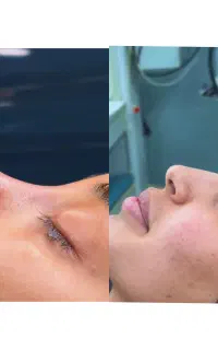 جراحی زیبایی بینی با تخفیف تا آخر خرداد