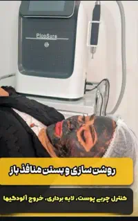 کربن تراپی روشن سازی پوست ورفع تیرگی نواحی بدن