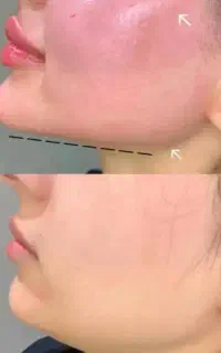 نیازمندمدل فیلربوتاکس فقط هزینه مواد،کارتوسط استاد