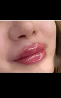تزریق فیلر لب،زاویه فک،باسن،الت تناسلی