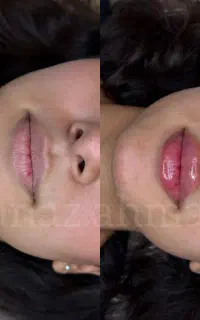 ژل*بوتاکس*آراف*لیزر