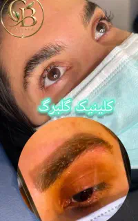 ریموو تتو ابرو و بدن(گلبرگ)