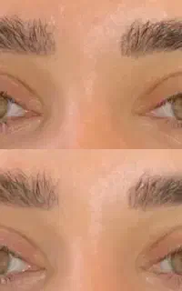 ژل-بوتاکس-مزوتراپی-prp-مزونیدلینگ