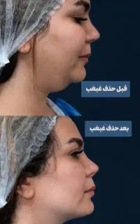 حذف غبغب با تخفیف ویژه محدود مناسب آقایان وخانم ها