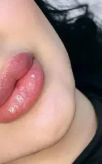 تزریق تکنیکی فیلر