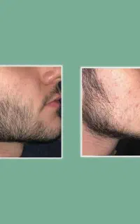 بی ریش کنسله